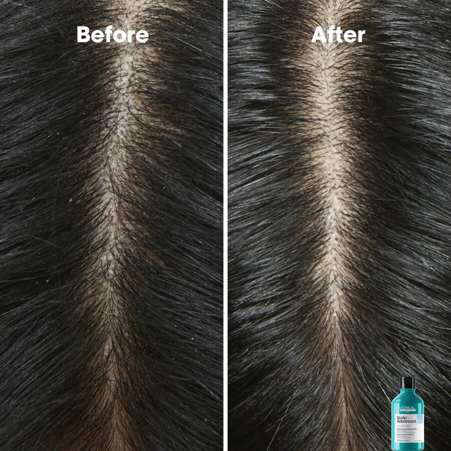 L’Oréal Anti-Dandruff Dermo-Clarifier Shampoo 300 ml