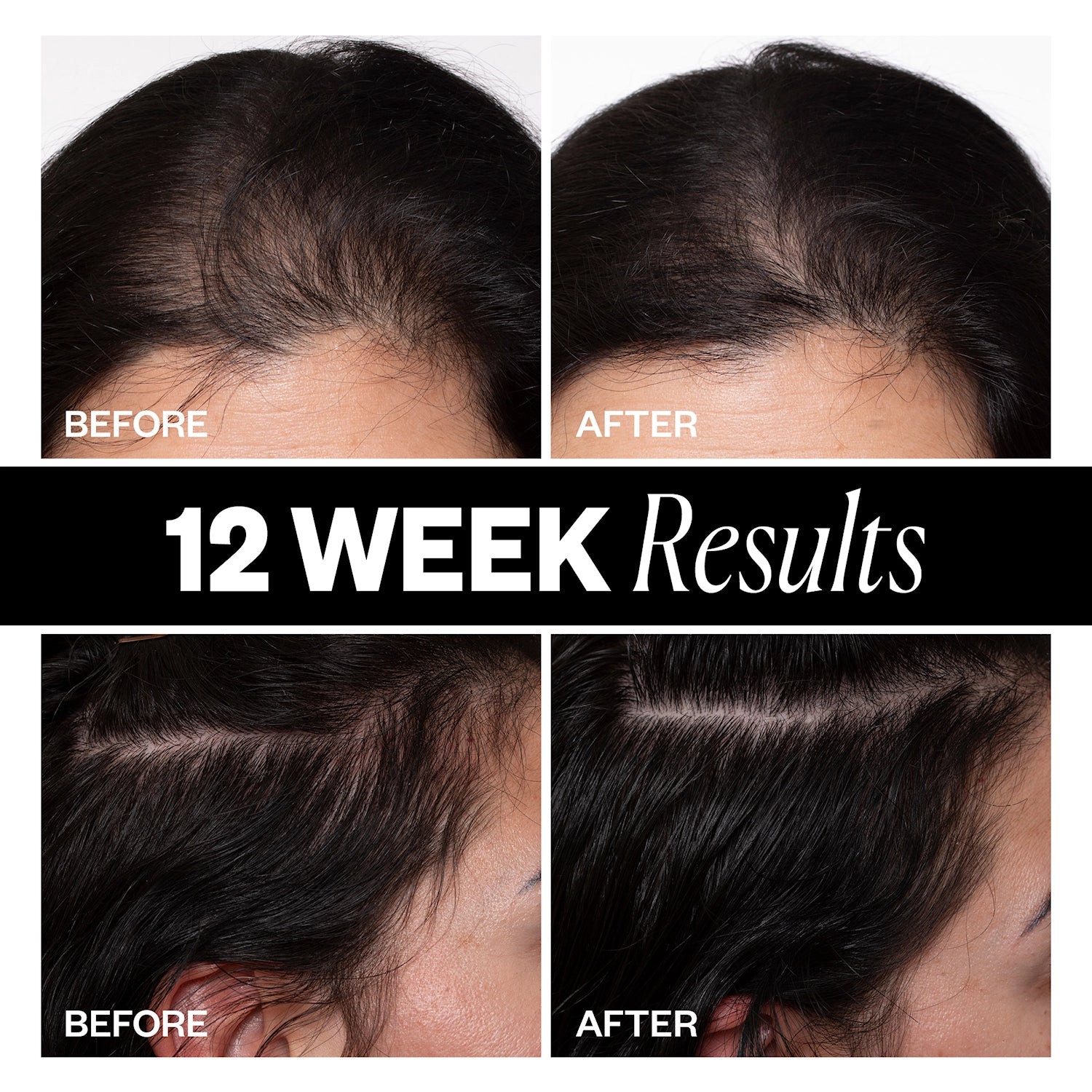 SPONSORED Hair Density Scalp Treatment